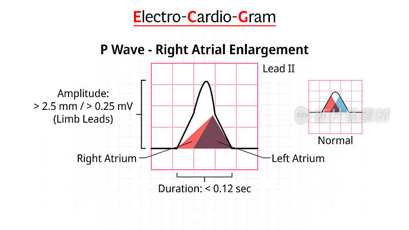 P波-心电图右心房扩张/肥厚-心电图-形态P波